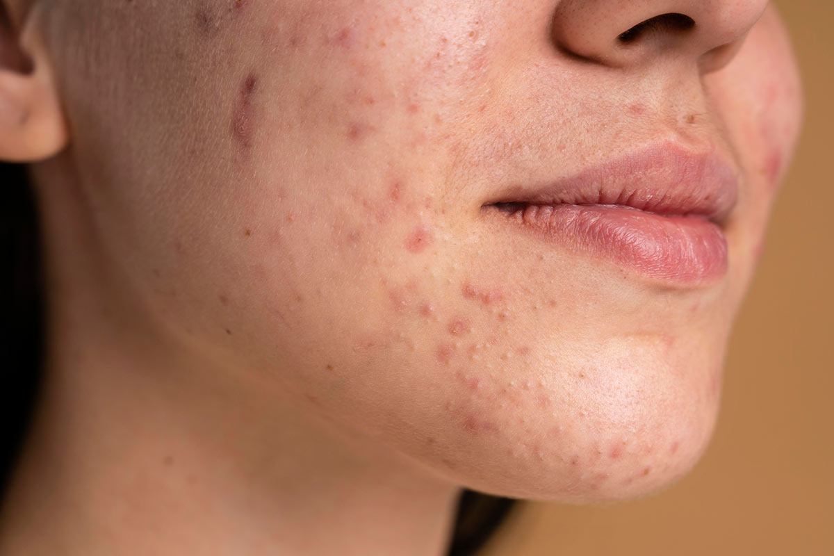 Você sabe o que é acne?