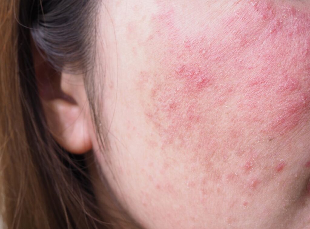 rosácea semelhante a acne com espinhas e pústulas 