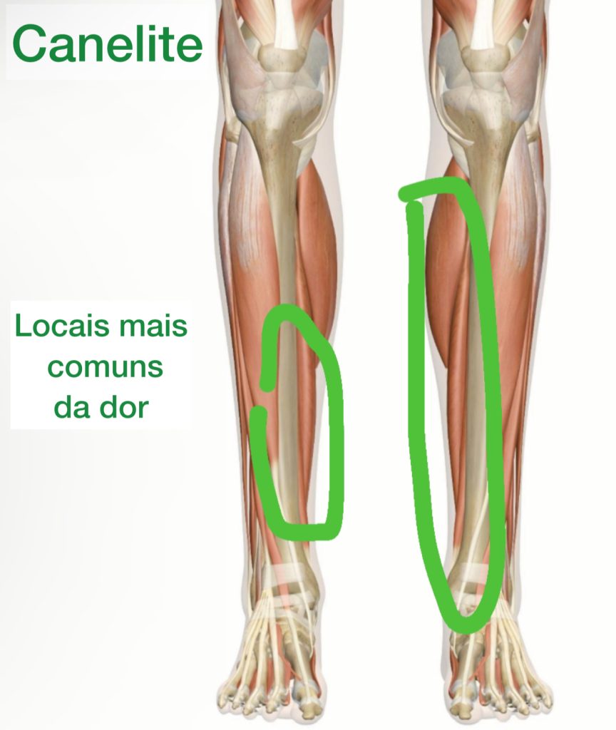 canelite marcada em verde nas regiões onde os sintomas são mais comuns