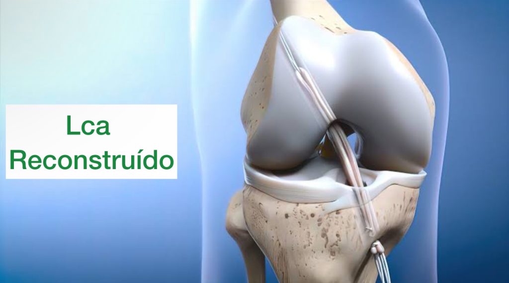 lesao do ligamento cruzado anterior, conseguimos ver que ele foi reconstruido