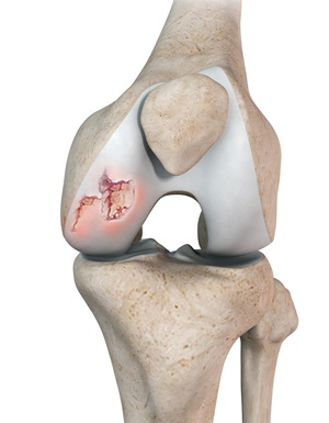 CONDROPATIA DE JOELHO MOSTRANDO LESÃO DA CARTILAGEM NO FEMUR