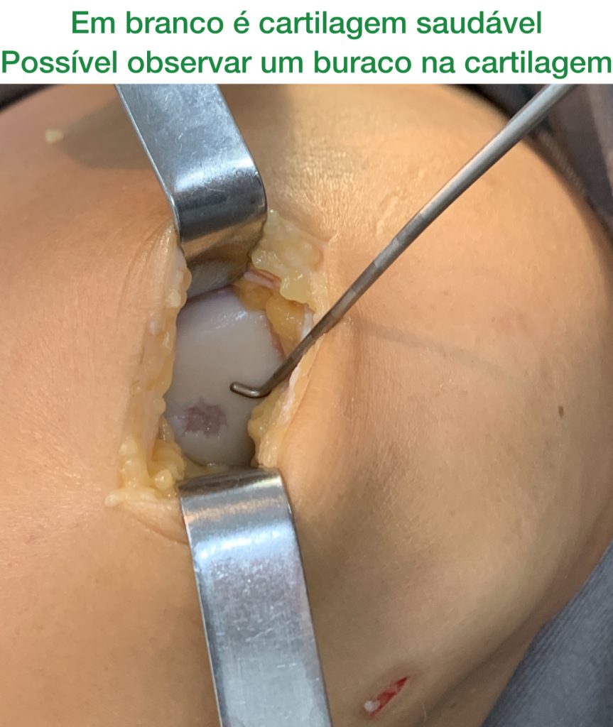 condropatia grau 4 do joelho - cirurgia membrana de colágeno