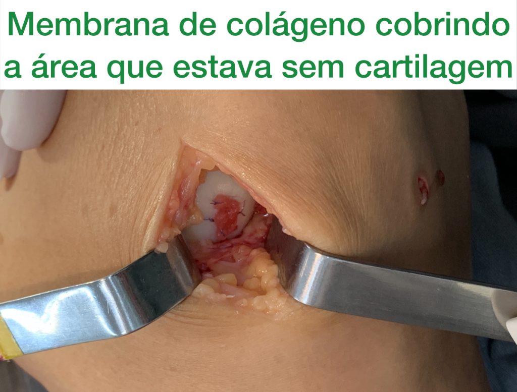 membrana de colágeno colocada em condropatia grau 4